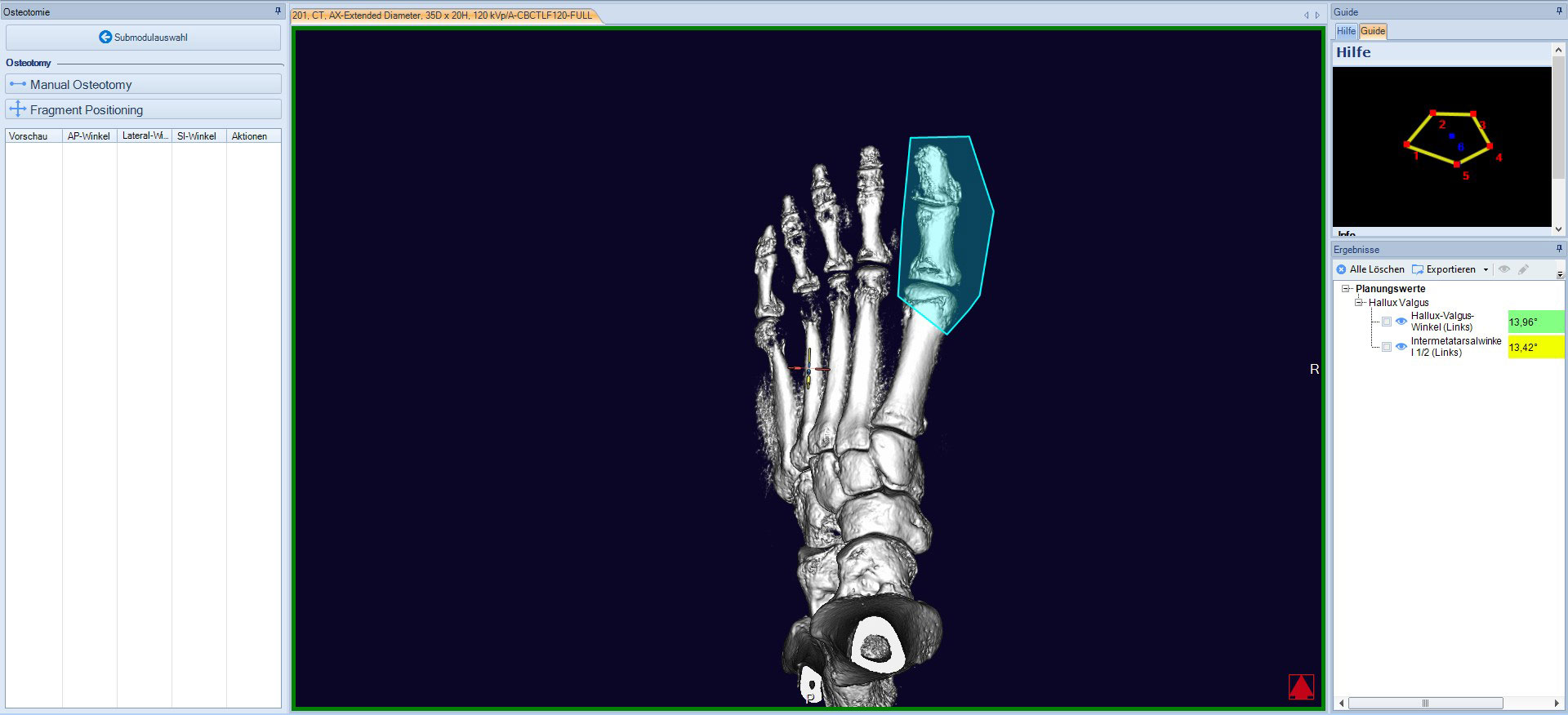 Hallux Valgus Osteotomie planen mit mediCAD 3D Foot