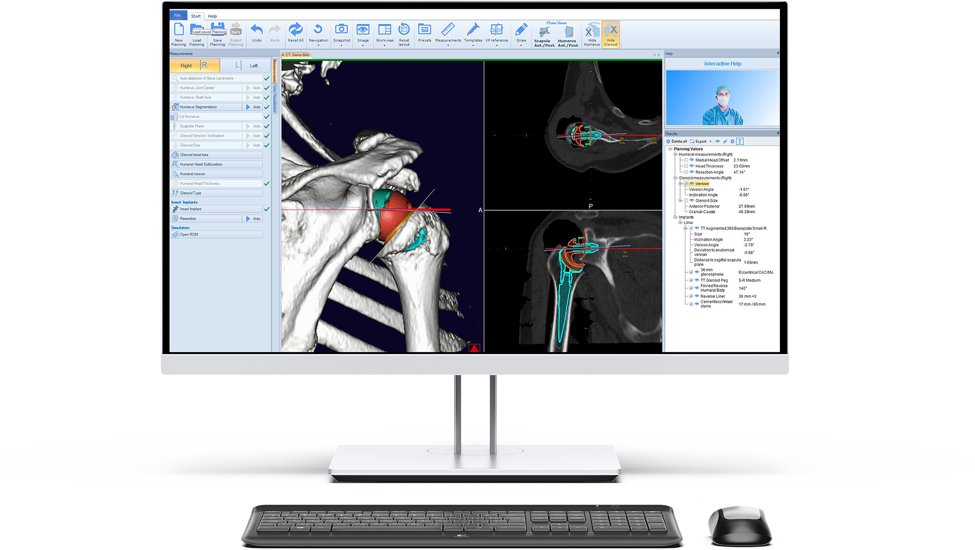 Operationsplanung mit der Software mediCAD für 2D und 3D Bilder